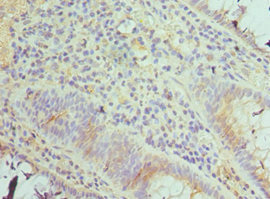 TAB1 Antibody - Immunohistochemistry of paraffin-embedded human colon cancer using TAB1 Antibody at dilution of 1:100