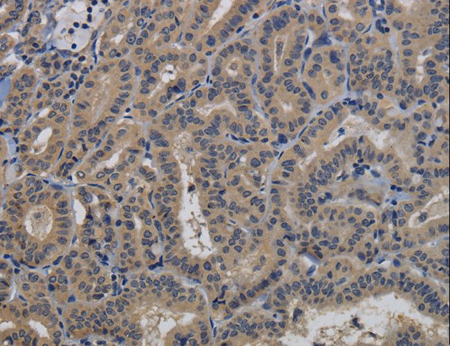TAB1 Antibody - Immunohistochemistry of paraffin-embedded Human thyroid cancer using TAB1 Polyclonal Antibody at dilution of 1:40.