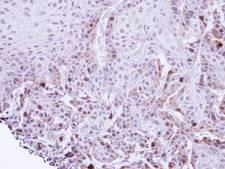 TACC2 Antibody - IHC of paraffin-embedded Cal27 xenograft using TACC2 antibody at 1:100 dilution.