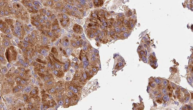 TACR1 / NK1R Antibody - 1:100 staining human liver carcinoma tissues by IHC-P. The sample was formaldehyde fixed and a heat mediated antigen retrieval step in citrate buffer was performed. The sample was then blocked and incubated with the antibody for 1.5 hours at 22°C. An HRP conjugated goat anti-rabbit antibody was used as the secondary.