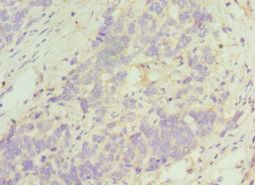 TACR3 / NK3R Antibody - Immunohistochemistry of paraffin-embedded human endometrial cancer using antibody at 1:100 dilution.
