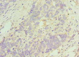 TACR3 / NK3R Antibody - Immunohistochemistry of paraffin-embedded human endometrial cancer using TACR3 Antibody at dilution of 1:100
