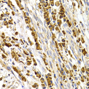 TACR3 / NK3R Antibody - Immunohistochemistry of paraffin-embedded human stomach cancer tissue.