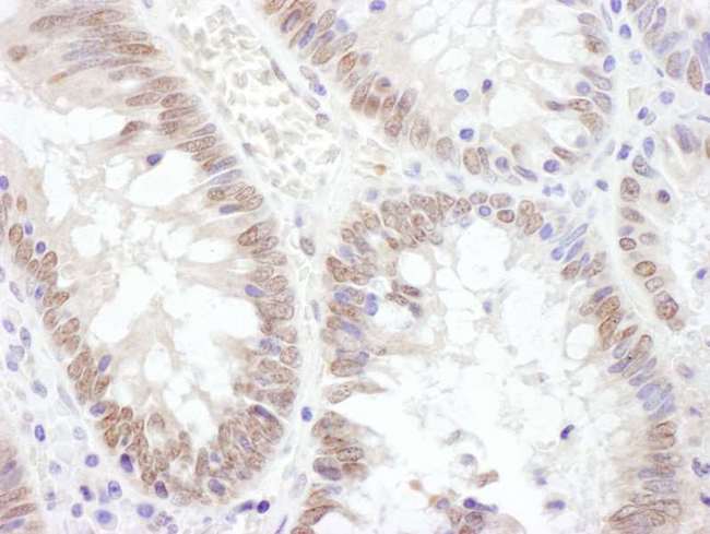 TAF1 Antibody - Detection of Human TAF1 by Immunohistochemistry. Sample: FFPE section of human colon carcinoma. Antibody: Affinity purified rabbit anti-TAF1 used at a dilution of 1:1000 (1 ug/ml). Detection: DAB.