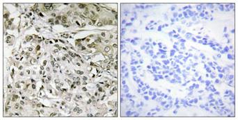TAF1 Antibody - Peptide - + Immunohistochemistry analysis of paraffin-embedded human breast carcinoma tissue, using TAF1 antibody.