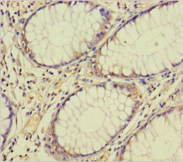 TAF12 Antibody - Immunohistochemistry of paraffin-embedded human colon cancer using TAF12 Antibody at dilution of 1:100