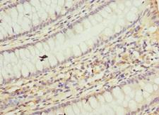 TAF12 Antibody - Immunohistochemistry of paraffin-embedded human breast cancer tissue at dilution 1:100
