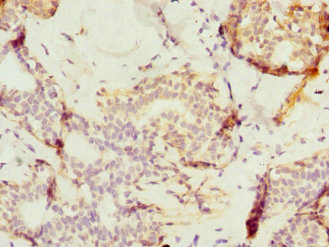 TAF12 Antibody - Immunohistochemistry of paraffin-embedded human colon cancer tissue at dilution 1:100