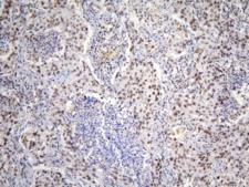 TAF12 Antibody - IHC staining of FFPE human lung cancer with TAF12 antibody at 1ug/ml. HIER: boil tissue sections in pH6, 10mM citrate buffer, for 10-20 min and allow to cool before testing.
