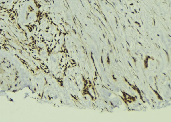 TAF12 Antibody - 1:100 staining human breast carcinoma tissue by IHC-P. The sample was formaldehyde fixed and a heat mediated antigen retrieval step in citrate buffer was performed. The sample was then blocked and incubated with the antibody for 1.5 hours at 22°C. An HRP conjugated goat anti-rabbit antibody was used as the secondary.