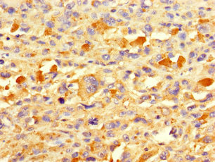 TAF13 Antibody - Immunohistochemistry of paraffin-embedded human melanoma using TAF13 Antibody at dilution of 1:100