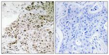 TAF13 Antibody - Peptide - + Immunohistochemistry analysis of paraffin-embedded human breast carcinoma tissue, using TAF13 antibody.