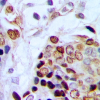 TAF15 Antibody - Immunohistochemical analysis of TAF15 staining in human prostate cancer formalin fixed paraffin embedded tissue section. The section was pre-treated using heat mediated antigen retrieval with sodium citrate buffer (pH 6.0). The section was then incubated with the antibody at room temperature and detected with HRP and DAB as chromogen. The section was then counterstained with hematoxylin and mounted with DPX.