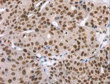 TAF15 Antibody - Immunohistochemistry of paraffin-embedded Human breast cancer using TAF15 Polyclonal Antibody at dilution of 1:35.
