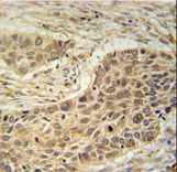 TAF1D Antibody - TAF1D Antibody immunohistochemistry of formalin-fixed and paraffin-embedded human lung carcinoma followed by peroxidase-conjugated secondary antibody and DAB staining.