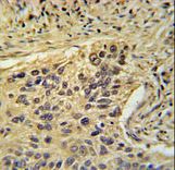 TAF2 Antibody - TAF2 Antibody immunohistochemistry of formalin-fixed and paraffin-embedded human lung carcinoma followed by peroxidase-conjugated secondary antibody and DAB staining.