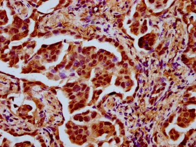 TAF4B Antibody - Immunohistochemistry Dilution at 1:500 and staining in paraffin-embedded human lung cancer performed on a Leica BondTM system. After dewaxing and hydration, antigen retrieval was mediated by high pressure in a citrate buffer (pH 6.0). Section was blocked with 10% normal Goat serum 30min at RT. Then primary antibody (1% BSA) was incubated at 4°C overnight. The primary is detected by a biotinylated Secondary antibody and visualized using an HRP conjugated SP system.