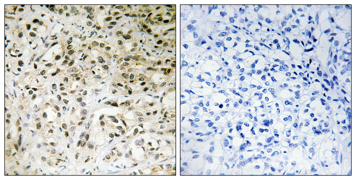 TAF5 Antibody - Immunohistochemistry analysis of paraffin-embedded human liver carcinoma tissue, using TAF5 Antibody. The picture on the right is blocked with the synthesized peptide.