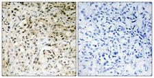 TAF5 Antibody - Immunohistochemistry analysis of paraffin-embedded human liver carcinoma tissue, using TAF5 Antibody. The picture on the right is blocked with the synthesized peptide.