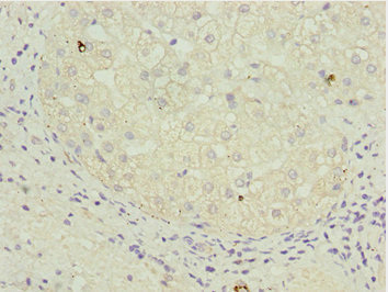 TAF5 Antibody - Immunohistochemistry of paraffin-embedded human liver cancer at dilution 1:100