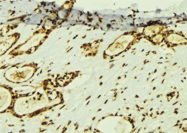 TAF5 Antibody - 1:100 staining human breast carcinoma tissue by IHC-P. The sample was formaldehyde fixed and a heat mediated antigen retrieval step in citrate buffer was performed. The sample was then blocked and incubated with the antibody for 1.5 hours at 22°C. An HRP conjugated goat anti-rabbit antibody was used as the secondary.