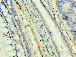 TAF5L Antibody - Immunohistochemistry of paraffin-embedded human colon cancer using antibody at 1:100 dilution.