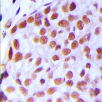 TAF5L Antibody - Immunohistochemical analysis of TAF5L staining in human breast cancer formalin fixed paraffin embedded tissue section. The section was pre-treated using heat mediated antigen retrieval with sodium citrate buffer (pH 6.0). The section was then incubated with the antibody at room temperature and detected with HRP and DAB as chromogen. The section was then counterstained with hematoxylin and mounted with DPX.