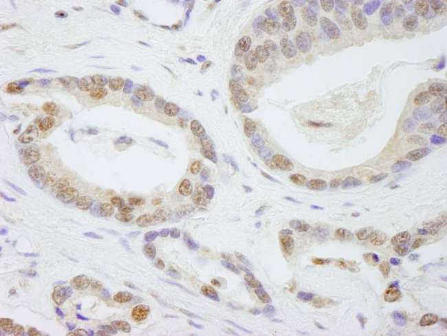 TAFII70 / TAF6 Antibody - Detection of Human TAF6 by Immunohistochemistry. Sample: FFPE section of human prostate carcinoma. Antibody: Affinity purified rabbit anti-TAF6 used at a dilution of 1:250.