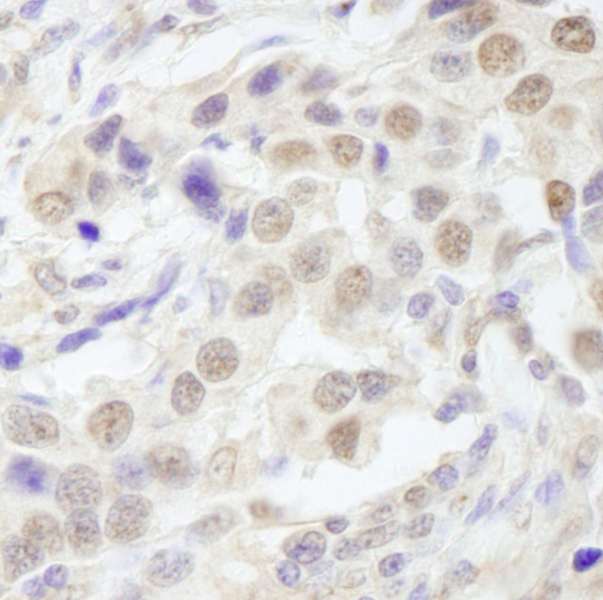 TAFII70 / TAF6 Antibody - Detection of Human TAF6 by Immunohistochemistry. Sample: FFPE section of human breast carcinoma. Antibody: Affinity purified rabbit anti-TAF6 used at a dilution of 1:250.