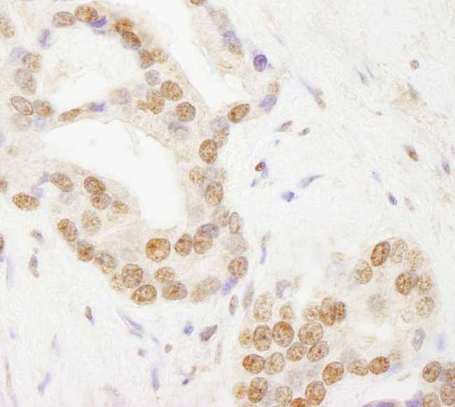 TAFII70 / TAF6 Antibody - Detection of Human TAF6 by Immunohistochemistry. Sample: FFPE section of human prostate carcinoma. Antibody: Affinity purified rabbit anti-TAF6 used at a dilution of 1:200 (1 ug/ml). Detection: DAB.