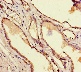 TAFII70 / TAF6 Antibody - Immunohistochemistry of paraffin-embedded human prostate cancer at dilution of 1:100