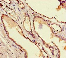 TAFII70 / TAF6 Antibody - Immunohistochemistry of paraffin-embedded human prostate cancer at dilution of 1:100