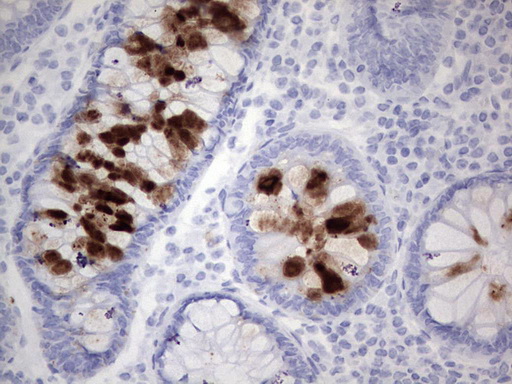 TAG-72 Antibody - IHC of paraffin-embedded Human colon tissue using anti-TAG 72-4 / CA 72-4 mouse monoclonal antibody.