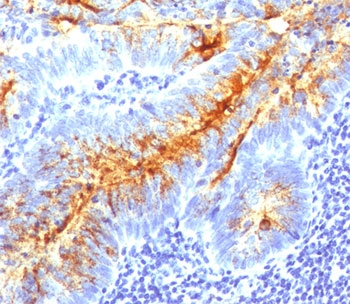 TAG-72 Antibody - TAG-72 antibody B72.3 + CA72/733 immunohistochemistry colon cancer.  This image was taken for the unmodified form of this product. Other forms have not been tested.