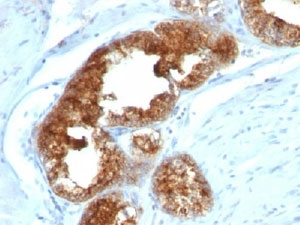 TAG-72 Antibody - IHC staining of human prostate carcinoma with TAG-72 antibody cocktail (B72.3 + CA72/733).