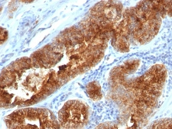 TAG-72 Antibody - Formalin-fixed, paraffin-embedded human prostate carcinoma stained with TAG-72 antibody (B72.3 + CC49).  This image was taken for the unmodified form of this product. Other forms have not been tested.