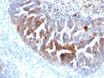 TAG-72 Antibody - Formalin-fixed, paraffin-embedded human ovarian carcinoma stained with TAG-72 antibody (B72.3 + CC49).  This image was taken for the unmodified form of this product. Other forms have not been tested.