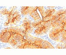 TAG-72 Antibody - TAG-72 antibody B72.3 immunohistochemistry colon cancer.  This image was taken for the unmodified form of this product. Other forms have not been tested.
