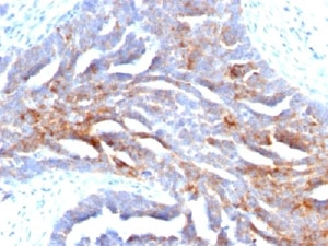 TAG-72 Antibody - IHC staining of human ovarian carcinoma with TAG-72 antibody
