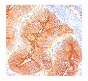 TAG-72 Antibody - TAG-72 antibody CA72/733 immunohistochemistry colon cancer.  This image was taken for the unmodified form of this product. Other forms have not been tested.