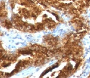 TAG-72 Antibody - IHC testing of human prostate carcinoma with TAG-72 antibody (CA72/733).