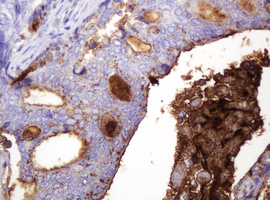 TAG-72 Antibody - IHC of paraffin-embedded Adenocarcinoma of Human breast tissue using anti-TAG-72 / CA 72-4 mouse monoclonal antibody.