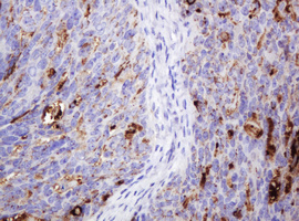 TAG-72 Antibody - IHC of paraffin-embedded Adenocarcinoma of Human ovary tissue using anti-TAG-72 / CA 72-4 mouse monoclonal antibody.