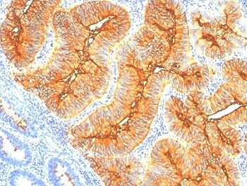 TAG-72 Antibody - Formalin-fixed, paraffin-embedded human colon carcinoma stained with TAG-72 antibody (SPM148).  This image was taken for the unmodified form of this product. Other forms have not been tested.