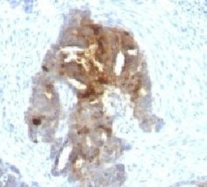 TAG-72 Antibody - IHC testing of human ovarian carcinoma with TAG-72 antibody.  This image was taken for the unmodified form of this product. Other forms have not been tested.