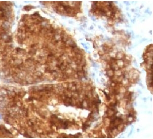 TAG-72 Antibody - IHC staining of human prostate carcinoma with TAG-72 antibody.  This image was taken for the unmodified form of this product. Other forms have not been tested.