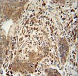 TAGAP Antibody - TAGAP antibody immunohistochemistry of formalin-fixed and paraffin-embedded human lung carcinoma followed by peroxidase-conjugated secondary antibody and DAB staining.