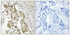 TAGAP Antibody - Immunohistochemistry analysis of paraffin-embedded human breast carcinoma, using TAGAP Antibody. The picture on the right is blocked with the synthesized peptide.