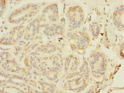 TAGAP Antibody - Immunohistochemistry of paraffin-embedded human breast cancer using antibody at dilution of 1:100.