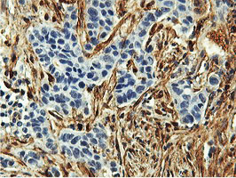 TAGLN / Transgelin / SM22 Antibody - IHC of paraffin-embedded Carcinoma of Human lung tissue using anti-TAGLN mouse monoclonal antibody.